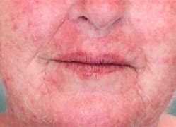 Image result for Allergic Reaction Hives On Face
