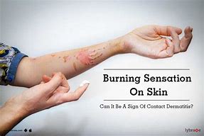 Image result for burn skin sensations