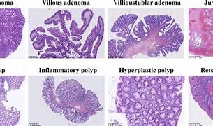 Image result for Colon Polyps Histology