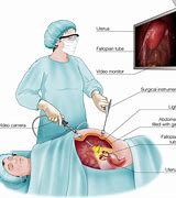 Image result for Laparoscopic Ovarian Cyst