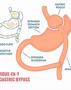 Image result for Gastric Bypass Surgery Glue