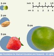 Image result for 2 Cm Tumor Size Of