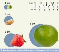 Image result for How Big Is 9 Cm Tumor