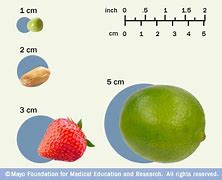 Image result for How Big Is 8 Cm Tumor