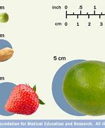 Image result for How Big Is a 6 Centimeter Tumor