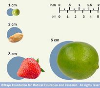 Image result for How Big Is a Centimeter Tumor
