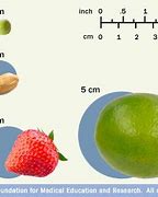 Image result for How Big Is 2 Cm Tumor