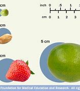 Image result for 1 Cm Tumor