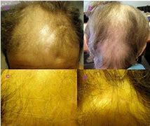 Image result for Tipos De Alopecia