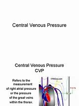 Image result for Centrel Venous Pressure