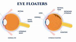 Image result for Eye Floater Shapes