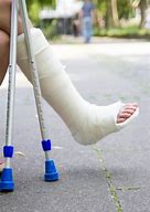 Image result for Broken Leg Plaster Cast