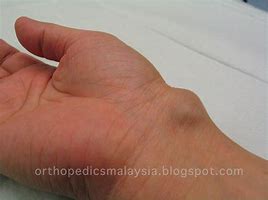 Image result for Hard Lump On Wrist