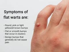 Image result for Flat Wart Treatment