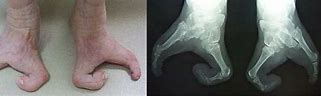 Image result for Lobster Claw Deformity