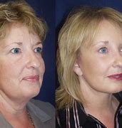 Image result for Types of Face Lifts
