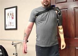 Image result for Prosthetic Arm above Elbow