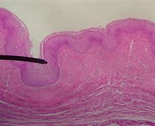 Image result for Genital Wart Histology