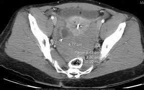 Image result for Ovarian Cyst Rupture Ultrasound