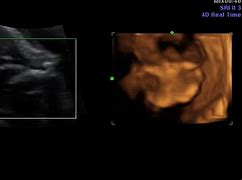 Image result for Anencephaly Radiograph
