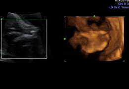 Image result for Anencephaly Scan