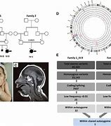 Image result for Primary Microcephaly