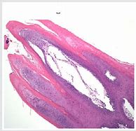 Image result for Lip Human Papillomavirus