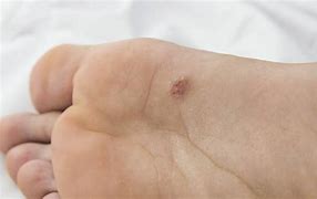 Image result for Flat Wart On Foot
