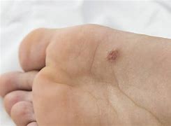 Image result for HPV Plantar Warts