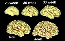 Image result for Premature Brain Development