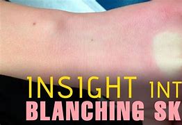 Image result for Blanching Skin Sun Burn