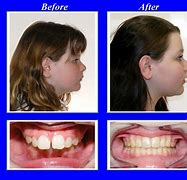 Image result for Person with Overbite