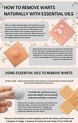 Image result for Home Remedy for Warts