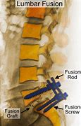 Image result for Lower Back Fusion