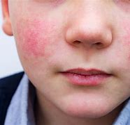 Image result for How Common Is Fifth Disease