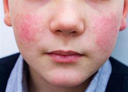 Image result for Fifth Disease Virus