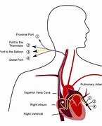 Image result for Arterial Bypass