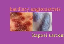 Image result for Bacillary Angiomatosis vs Kaposi Sarcoma