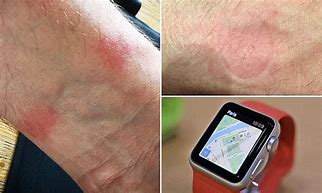 Image result for Apple Watch Burning Wrist