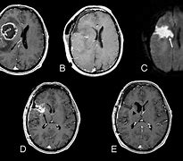 Image result for Brain Tumor Shrinking