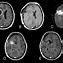 Image result for Brain Tumor Imaging