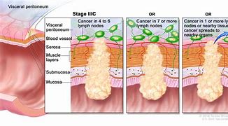 Image result for Stages of Colorectal Cancer