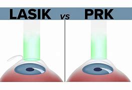 Image result for PRK Marks vs Lasik