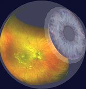Image result for Retina Eye Exam