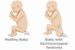 Image result for Teratoma Baby Boy