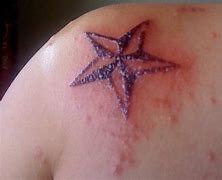 Image result for Allergic Reaction to Red Tattoo Ink