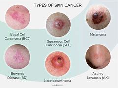 Image result for What Does Skin Cancer Look Like