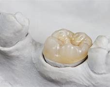 Image result for Overlay Teeth