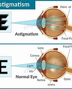 Image result for Eye Scan Astigmatism