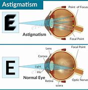 Image result for Astigmatism Example Text